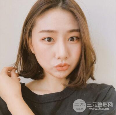 西安叶子鲁礼新埋线双眼皮案例对照图!两个月恢复心情小记