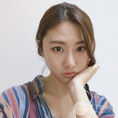 西安叶子鲁礼新埋线双眼皮案例对照图!两个月恢复心情小记