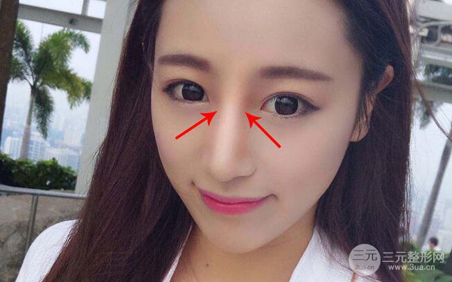 隆鼻能保持多久 是永.久的吗？