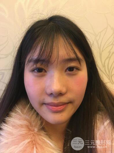 苏州紫馨孙影塌鼻子假体隆鼻案例对比照心情小札