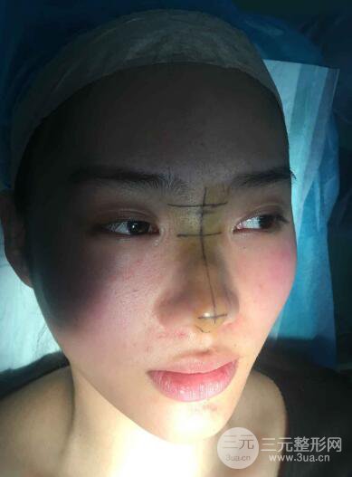 苏州紫馨孙影塌鼻子假体隆鼻案例对比照心情小札