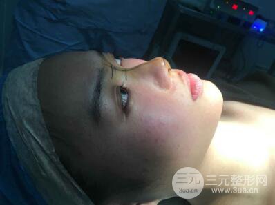 苏州紫馨孙影塌鼻子假体隆鼻案例对比照心情小札