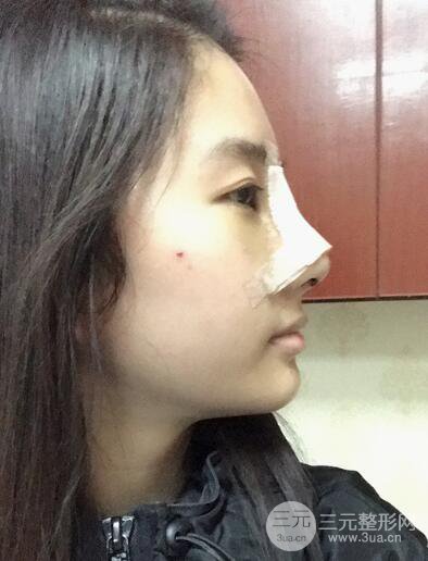 苏州紫馨孙影塌鼻子假体隆鼻案例对比照心情小札
