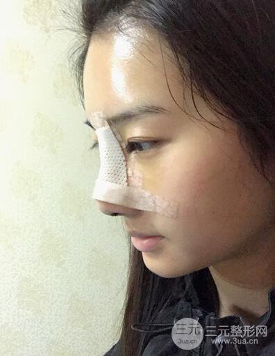 苏州紫馨孙影塌鼻子假体隆鼻案例对比照心情小札