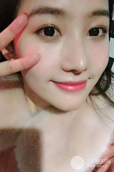 苏州紫馨孙影塌鼻子假体隆鼻案例对比照心情小札