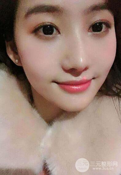 苏州紫馨孙影塌鼻子假体隆鼻案例对比照心情小札