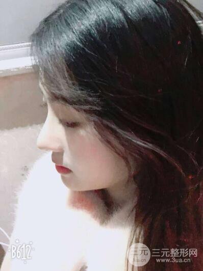 苏州紫馨孙影塌鼻子假体隆鼻案例对比照心情小札