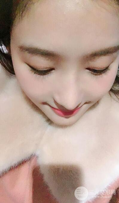 苏州紫馨孙影塌鼻子假体隆鼻案例对比照心情小札