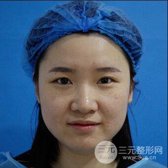 贵阳美莱梁洁芭比媚双眼皮多项整形前后对比图恢复心情小札