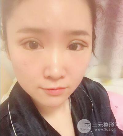 贵阳美莱梁洁芭比媚双眼皮多项整形前后对比图恢复心情小札