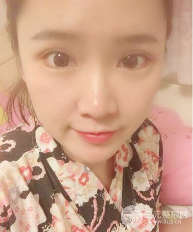 贵阳美莱梁洁芭比媚双眼皮多项整形前后对比图恢复心情小札