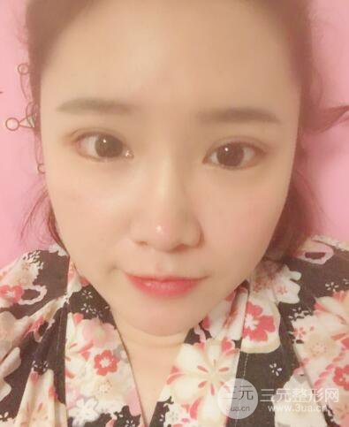 贵阳美莱梁洁芭比媚双眼皮多项整形前后对比图恢复心情小札