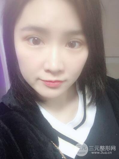 贵阳美莱梁洁芭比媚双眼皮多项整形前后对比图恢复心情小札