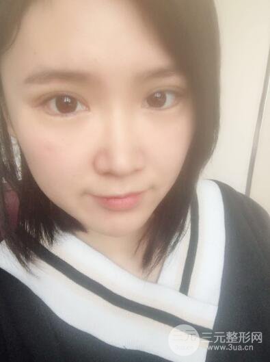 贵阳美莱梁洁芭比媚双眼皮多项整形前后对比图恢复心情小札