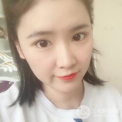 贵阳美莱梁洁芭比媚双眼皮多项整形前后对比图恢复心情小札