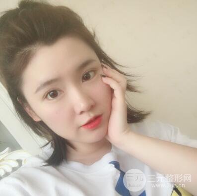 贵阳美莱梁洁芭比媚双眼皮多项整形前后对比图恢复心情小札