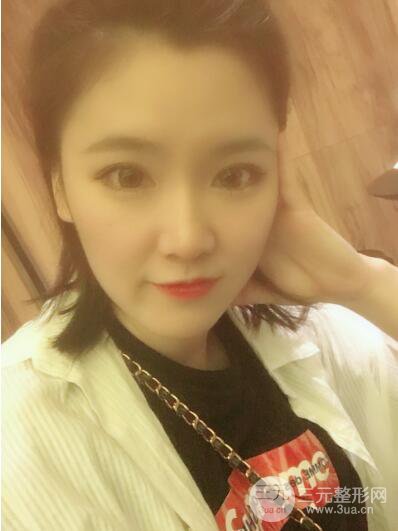 贵阳美莱梁洁芭比媚双眼皮多项整形前后对比图恢复心情小札