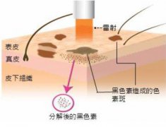 激光祛斑的价格?激光祛斑价格是多少?