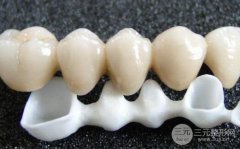 纯钛烤瓷牙价格是多少?纯钛烤瓷牙费用?