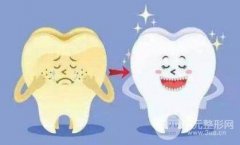 美容牙多少钱一颗?