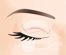 无切口埋线双眼皮怎么样