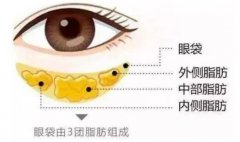 超声法祛眼袋价格是多少?超声法祛眼袋价格贵吗?