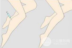 打注射瘦腿有果吗?打注射瘦腿果好不好？