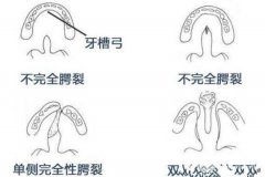 唇腭裂可以修复吗?