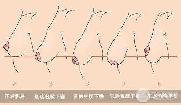巨大乳房缩小和隆胸有什么区别？