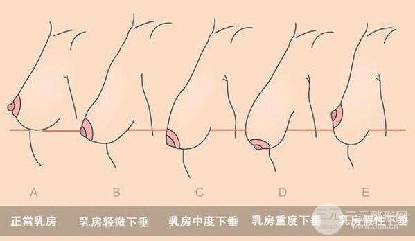 巨大乳房缩小和隆胸有什么区别?