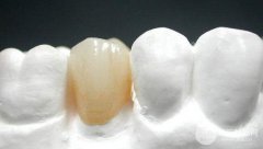 贵金属烤瓷牙的种类,铂钯合金金属烤瓷牙好不好