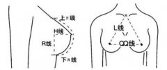 什么是隆胸手术？隆胸手术的注意事项？