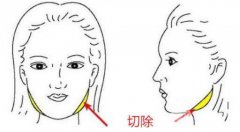咬肌切除手术需要多少钱?影响价格的因素有哪些?