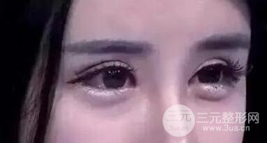 割双眼皮已经一年了 为什么还能被看出来?