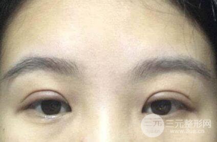 割双眼皮已经一年了 为什么还能被看出来?