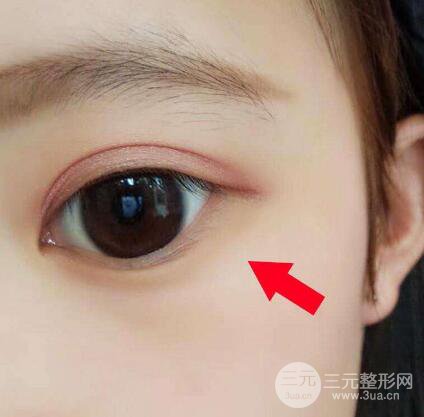 割双眼皮已经一年了 为什么还能被看出来?