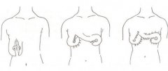 乳房再造手术是怎样的?有哪些优点?