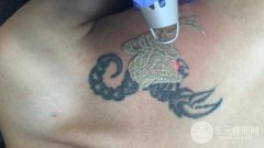 激光洗纹身果怎么样？激光洗纹身果好不好？