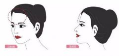玻尿酸丰额头肿几天?多久可以恢复?