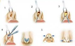 取出假体危险吗?取出假体危险性怎么样?