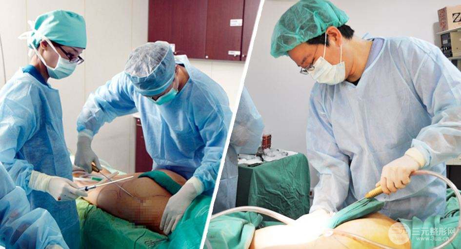 抽脂是什么抽脂有什么好处