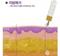 什么是激光溶脂?激光溶脂是怎么工作的?