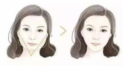 玻尿酸丰下巴有危害吗?玻尿酸的危害有哪些呢?