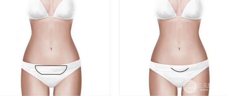 360度吸脂减肥多久恢复