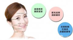 激光祛斑一次有吗?激光祛斑果怎么样?