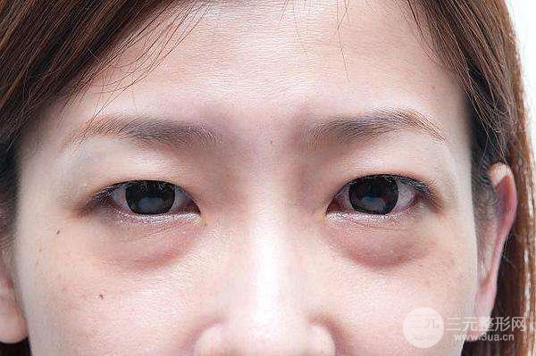 去眼袋手术有副作用吗?眼袋手术会有什么副作用?