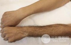 脱毛前后果对比 脱毛之后需要怎么护理