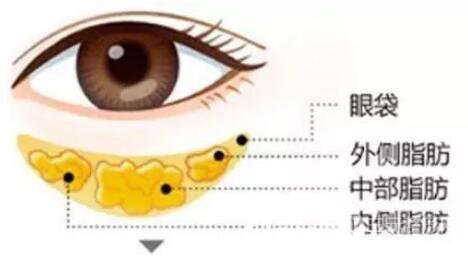 内路祛眼袋多少钱?内路祛眼袋费用是多少?
