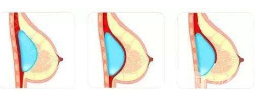 假体隆胸疤痕增生怎么办