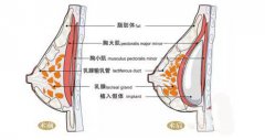 小胸女孩整形须知：蜜桃假体隆胸的危害性